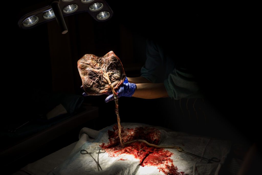 De placenta wotdt na de geboorte omhoog gehouden.